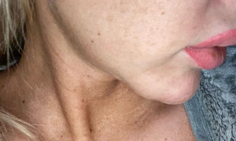 Mini Face Lifting mit 28 Jahren möglich? - 28998