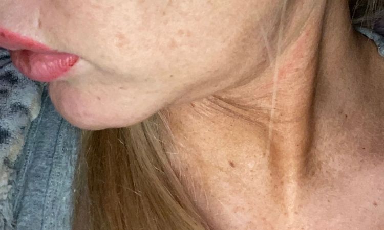 Mini Face Lifting mit 28 Jahren möglich? - 29000