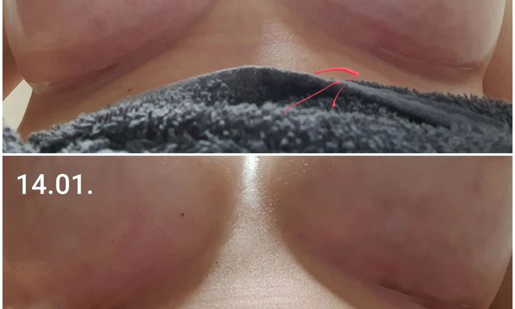 Brustvergrößerung innere Naht gerissen - 29025
