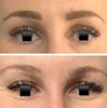 Augenbrauenanhebung - Operation oder Botoxbehandlung? 