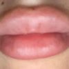 Suche Arzt in der Schweiz für Lippenvergrößerung - 29054