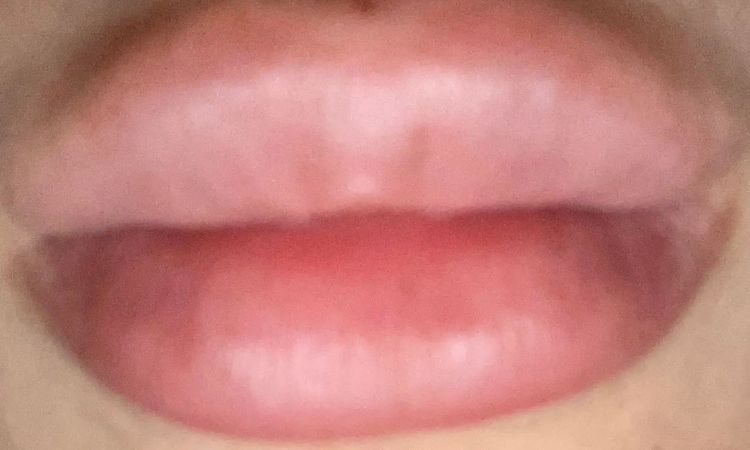 Suche Arzt in der Schweiz für Lippenvergrößerung - 29054