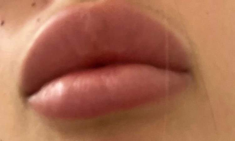 Suche Arzt in der Schweiz für Lippenvergrößerung - 29055