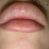 Suche Arzt in der Schweiz für Lippenvergrößerung - 29056