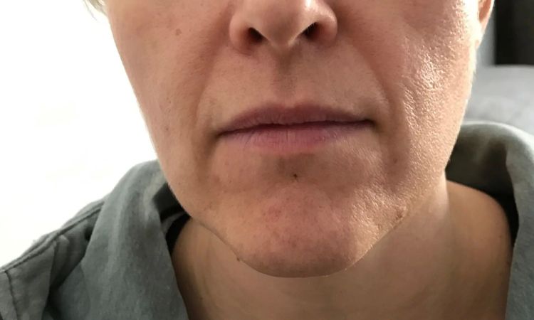 Nasolabialfalte mit Filler oder besser mit Fadenlifting behandeln? - 29110