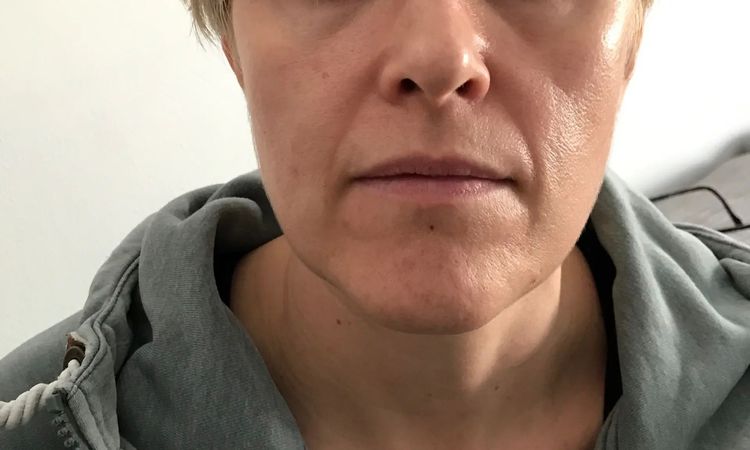 Nasolabialfalte mit Filler oder besser mit Fadenlifting behandeln? - 29111