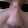 Narbe auf Nasenrücken immer noch gerötet nach 7 Wochen - 29149