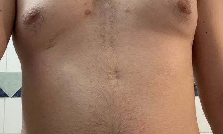 Z.n GYNÄKOMASTIE- OP / Brust wieder vergrößert durch Gewichtszunahme? - 29164