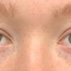 asymmetrische Augen / hängendes Augenlid/ Welche Behandlung?