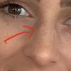 Nasenkorrektur ohne Op mit Hyaloronsäure oder Fäden? - 29208