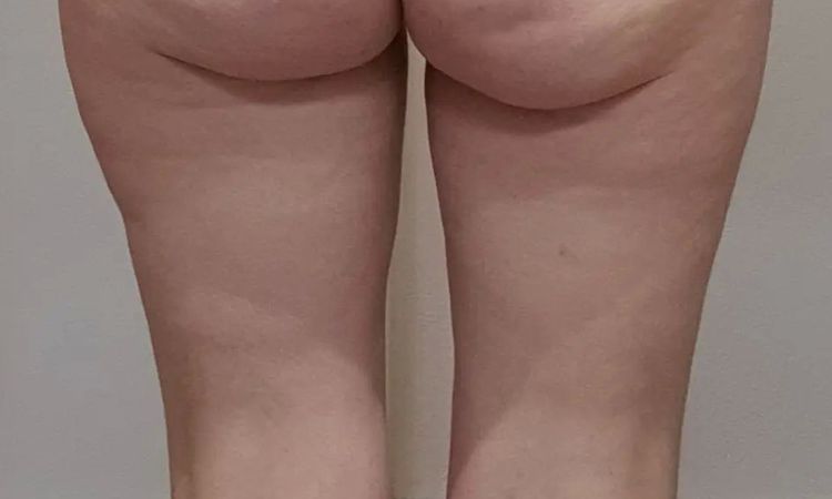 Fettabsaugung Beine/Po/ Welche Methode ist geeignet? - 29231