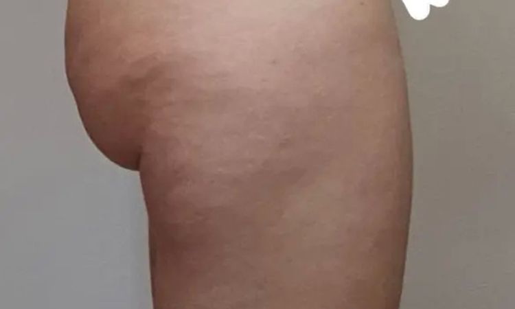 Fettabsaugung Beine/Po/ Welche Methode ist geeignet? - 29232