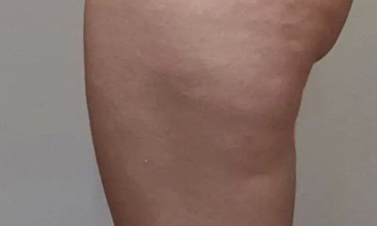 Fettabsaugung Beine/Po/ Welche Methode ist geeignet? - 29233
