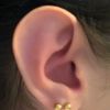 Fehlender Helix am rechten Ohr/ Welche Behandlung
