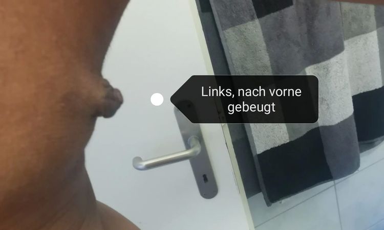 Unzufrieden nach Gynäkomastie OP/ Was tun? - 29259