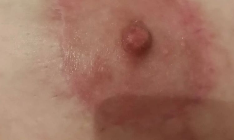Korrektur nach Bruststraffung mit Implantaten - 29301