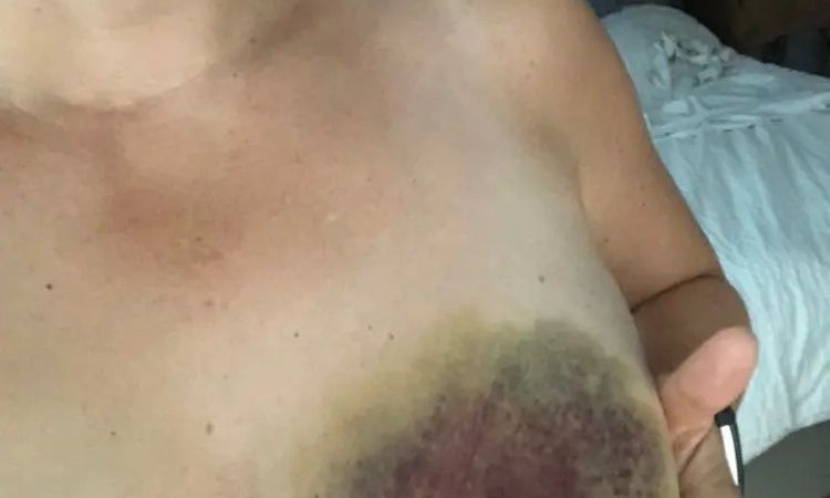 Brustverkleinerung nach Biopsie mit Hämatom - 29406