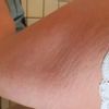 Lipofilling mit entfernen der Dellen und Löcher in den Beinen  - 29445