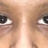 Behandlungsmethode bei dunklen Augenringen - 29475