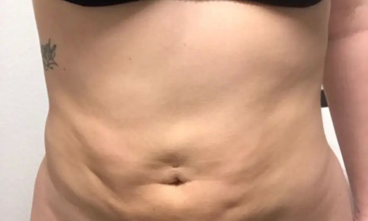 Nach Korrektur wieder Falten und Dellen am Bauch  - 29544