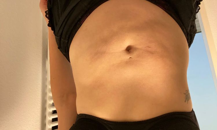 Nach Korrektur wieder Falten und Dellen am Bauch  - 29545