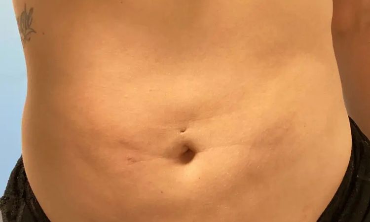 Nach Korrektur wieder Falten und Dellen am Bauch  - 29546