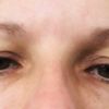 Welche Behandlung um Augenlider zu korrigieren? - 29555