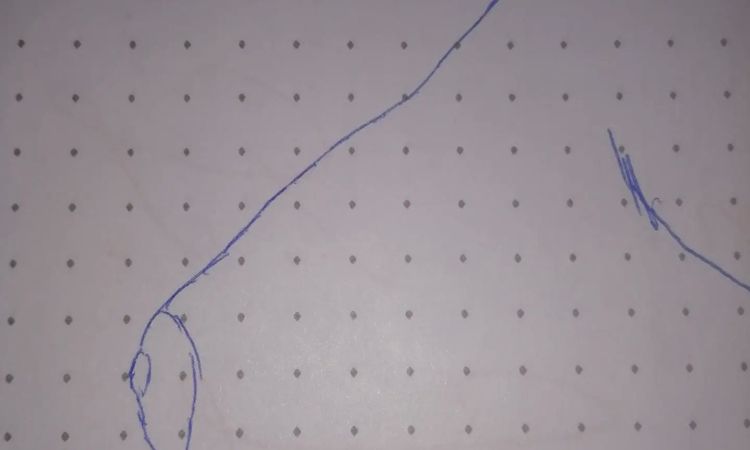 Unzufrieden nach OP: tubuläre Brust und Anistmastie 2.-3. Grades - 29572