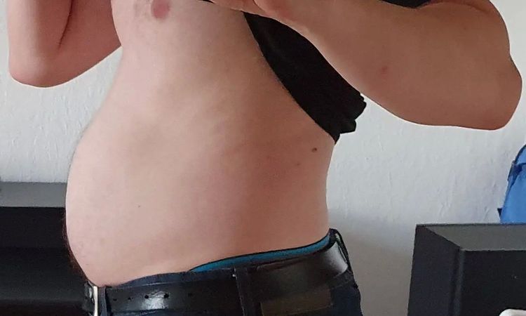 Fettabsaugung am Bauch bei M1 Beauty - 29588