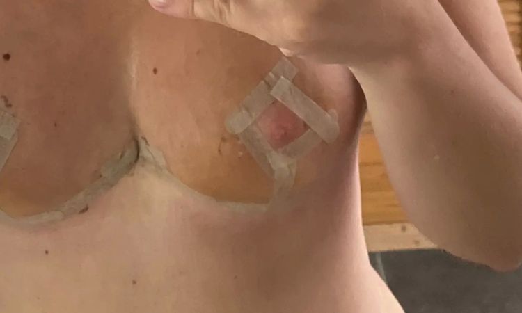 Brust zu klein nach Brustverkleinerung!? - 29589