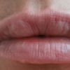Knubbel nach Lippenbehandlung mit dermasmile - 29601
