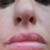 Knubbel nach Lippenbehandlung mit dermasmile - 29602