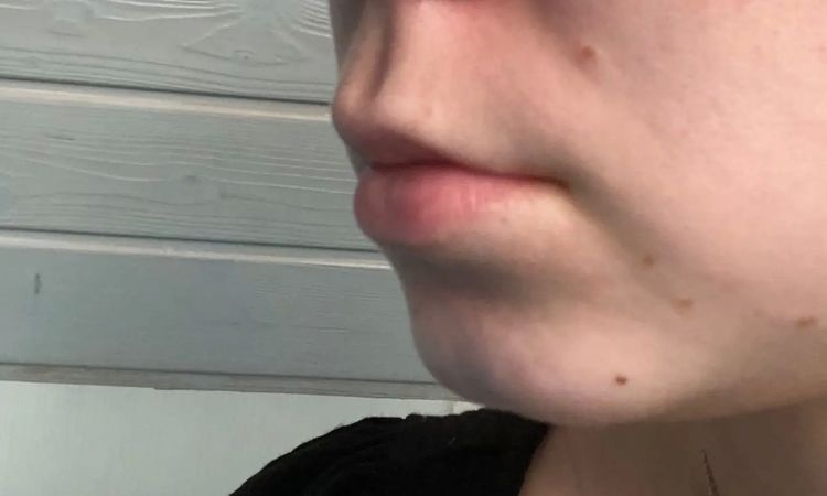 Erfahrungen mit LipLift? - 29613