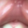 Verkapslung oder Granulom nach Lippenunterspritzung  - 29630