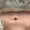Stufenbildung Narbe Unterbauch 3 Monate nach BDS