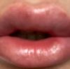 Hilfe- Lippen asymmetrisch angeschwollen - 29678