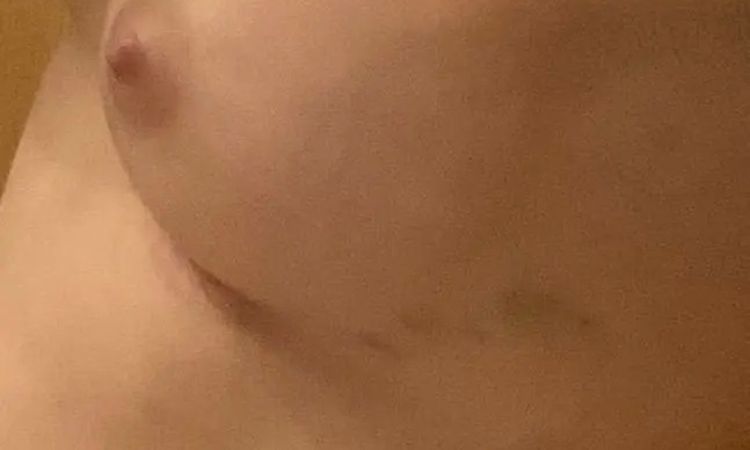 Erneut Schmerzen und Hämatom 22 Tage post OP - 29691