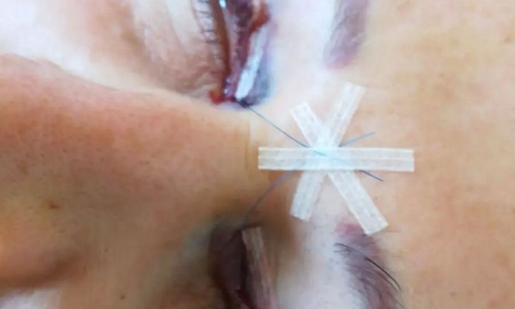 Hauttransplantation nach Oberlidstraffung - 29711