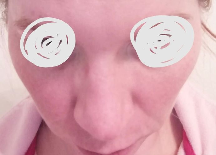 nase geschwollen 2 monate post op Estheticon.de