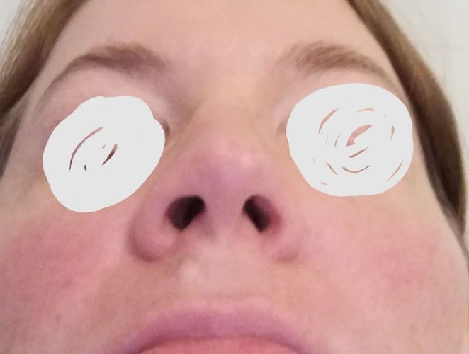 nase geschwollen 2 monate post op Estheticon.de