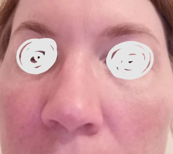 nase geschwollen 2 monate post op Estheticon.de