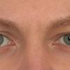 Asymmetrische Augen korrigieren - 29735