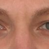 Asymmetrische Augen korrigieren - 29736