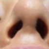 Nasenlöcher unterschiedlich und schiefe Nasenspitze  - 29739