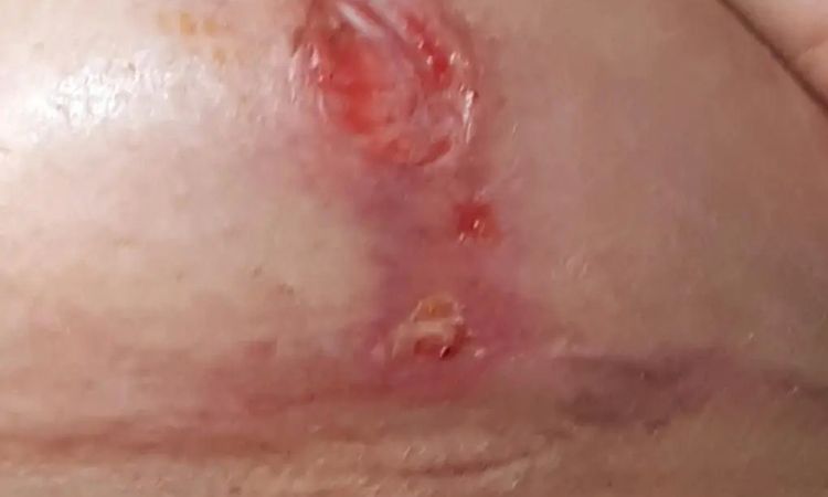 Hilfe? Entzündung nach Bruststraffung mit Implantaten - 29763