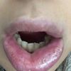 Allergische Reaktion nach Lippen aufspritzen? - 29885