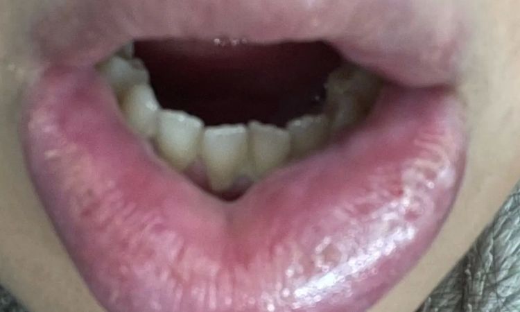 Allergische Reaktion nach Lippen aufspritzen? - 29885