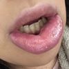 Allergische Reaktion nach Lippen aufspritzen? - 29886