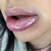 Allergische Reaktion nach Lippen aufspritzen? - 29887