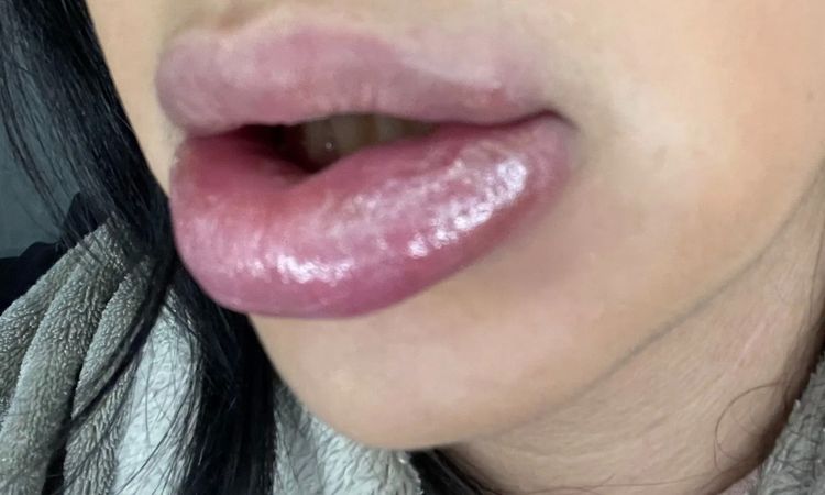 Allergische Reaktion nach Lippen aufspritzen? - 29887